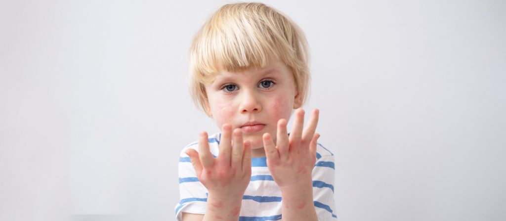 Atopijski dermatitis kod dece